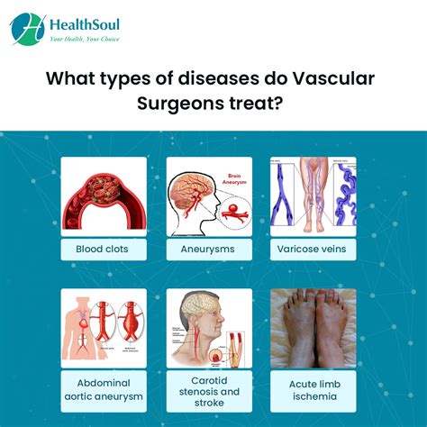 Vascular Disease: Types, Causes, Symptoms and Treatment.